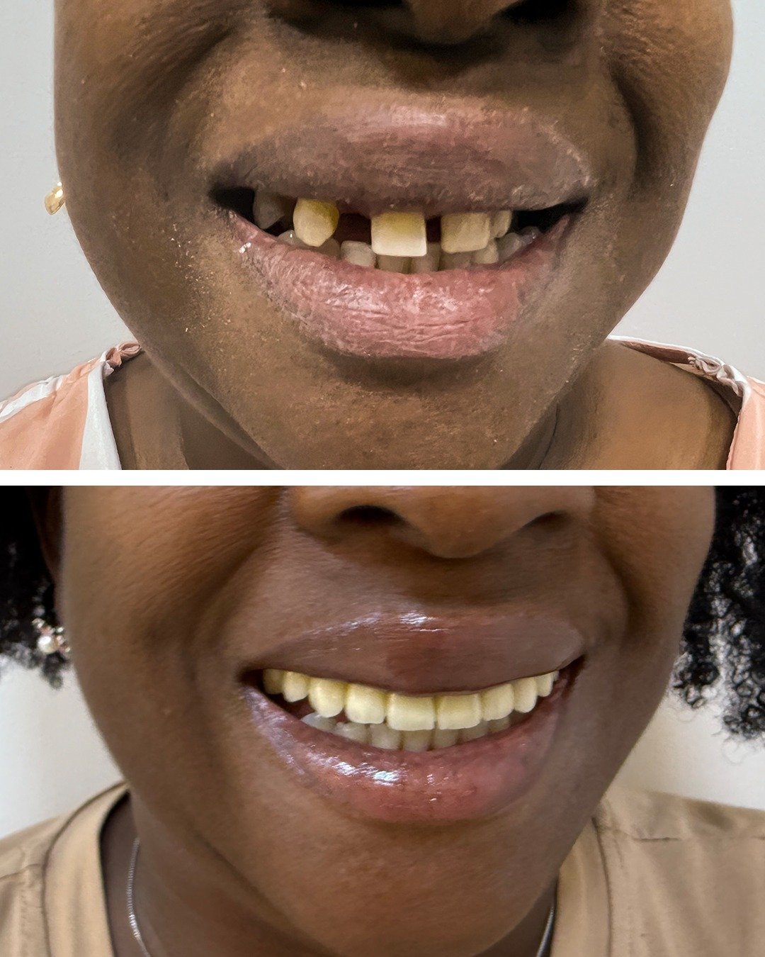 Antes e depois — Reabilitação com implantes · paciente real IEB